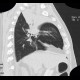 Atelectasis of right upper lobe of lung: CT - Computed tomography